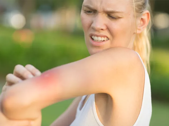 žena s bodnutím od hmyzu na paži